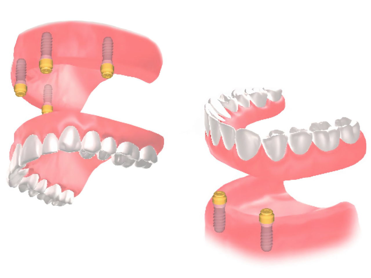 インプラント　オーバーデンチャー　新松戸　歯科