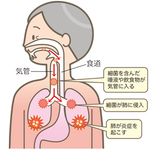 新松戸すこやか歯科　予防　検診　健診　歯周病　誤嚥性肺炎