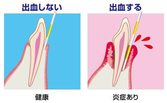 歯周病　歯ぐき　出血　予防　新松戸　歯科