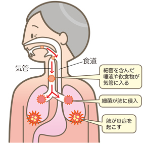 誤嚥性肺炎　予防　新松戸　歯科