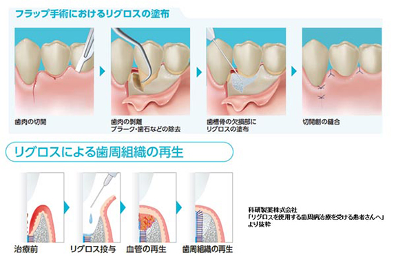 歯周病の治療 - 新松戸すこやか歯科（新松戸）