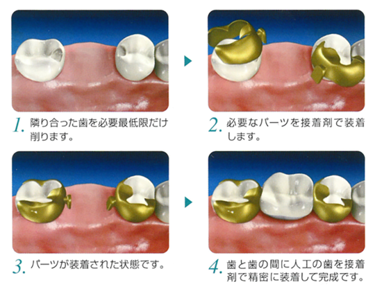 「和田精密歯研株式会社 ヒューマンブリッジ　画像」の画像検索結果