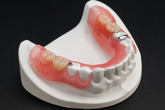 入れ歯（義歯）の治療 - 新松戸すこやか歯科（新松戸）